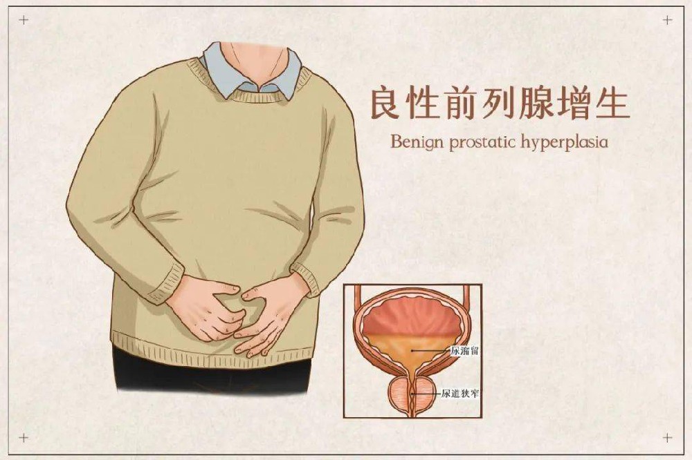男性前列腺肥大如何调理?中医疗法的核心优势全解析